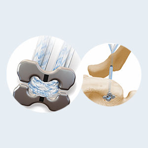 bouton de suture pour reconstruction du ligament acromio-claviculaire