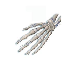 vis de compression à os de phalange de la main