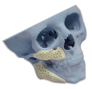 implant périorbital sur mesure