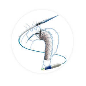 stent-greffe d'aorte thoracique ascendante