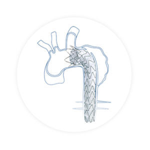stent-greffe d'aorte thoracique ascendante