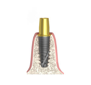 pilier implantaire cylindrique conique