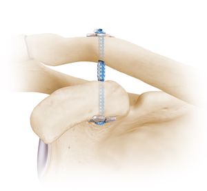 bouton de suture pour reconstruction du ligament acromio-claviculaire
