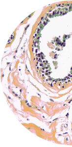 kit de test pour cancer du sein