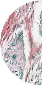 kit de test pour le cancer du pancréas