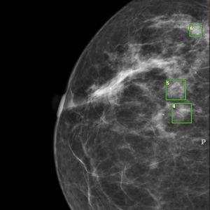 logiciel pour dépistage du cancer du sein