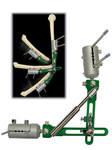 fixateur externe de coude