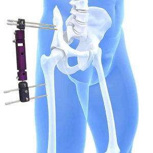 fixateur externe de pelvis