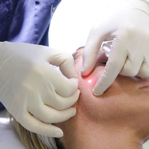 laser pour rajeunissement de la peau