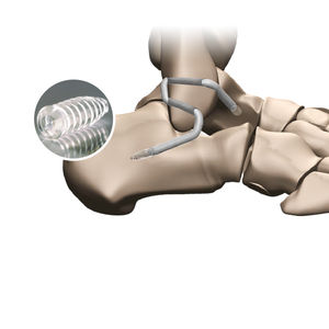 prothèse ligamentaire de tendon gracile