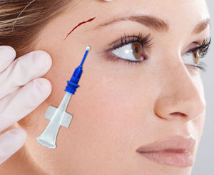 colle chirurgicale pour suture cutanée