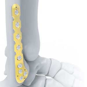 plaque de compression de fibula
