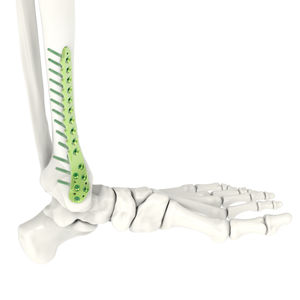 plaque de compression de tibia