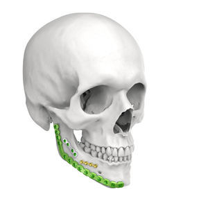 plaque de compression de mandibule