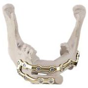 plaque de compression de mandibule