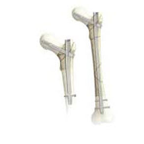 clou intramédullaire trochanter
