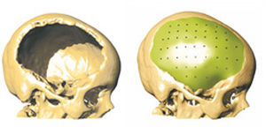 implant crânien sur mesure