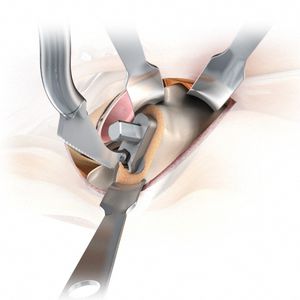 kit d'instruments pour chirurgie de la hanche mini invasive