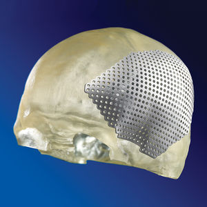 implant crânien