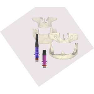 implant dentaire cylindrique