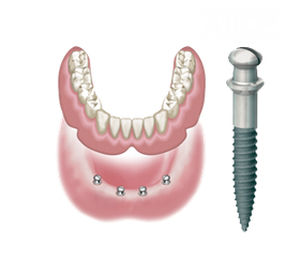 implant dentaire conique