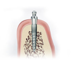 implant dentaire en titane