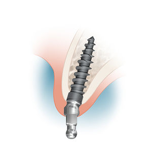 implant dentaire en titane