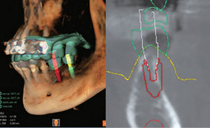 logiciel de planification / de simulation d'implant dentaire / FAO / de conception de prothèse dentaire