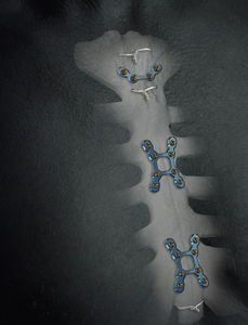 plaque de compression de sternum