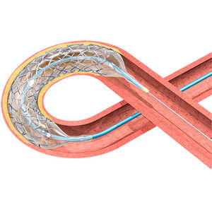 stent coronarien