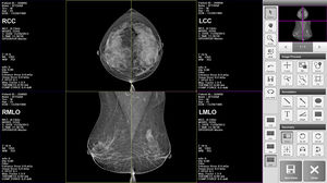 logiciel pour mammographie