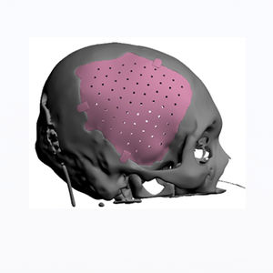 implant crânien sur mesure