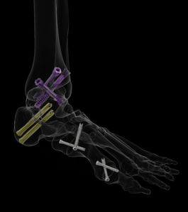 vis de compression à os de pied