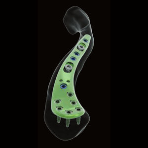 plaque de compression de clavicule