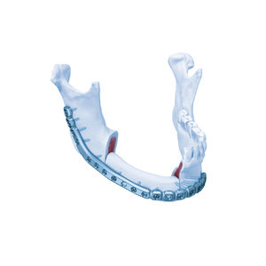 plaque de compression mandibule
