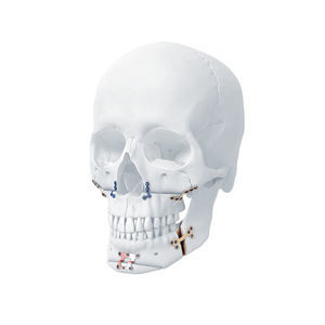 plaque de compression de mandibule