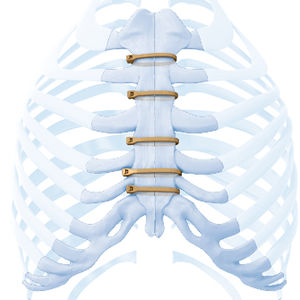 fil de cerclage orthopédique pour fermeture sternale