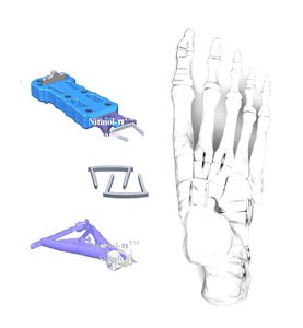 agrafe orthopédique de petit fragment osseux