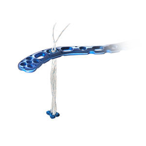 bouton de suture pour reconstruction du ligament acromio-claviculaire