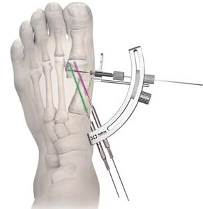 kit d'instruments pour chirurgie mini-invasive de l'avant-pied