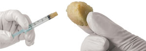 substitut osseux allogreffe