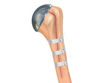 cerclage orthopédique pour fracture périprothétique