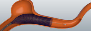stent intracrânien / en nitinol / auto-expansible