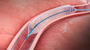 stent coronarien