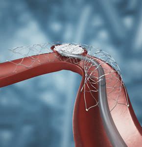 stent intracrânien