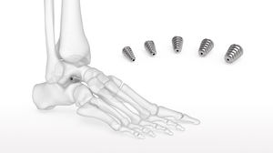 implant d'articulation sub-talaire