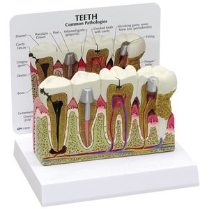 modèle anatomique de dents / pathologique