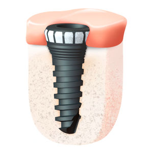 implant dentaire conique