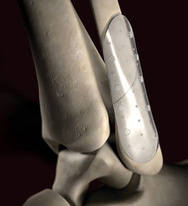 plaque de compression de radius