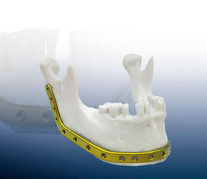 plaque de compression de mandibule